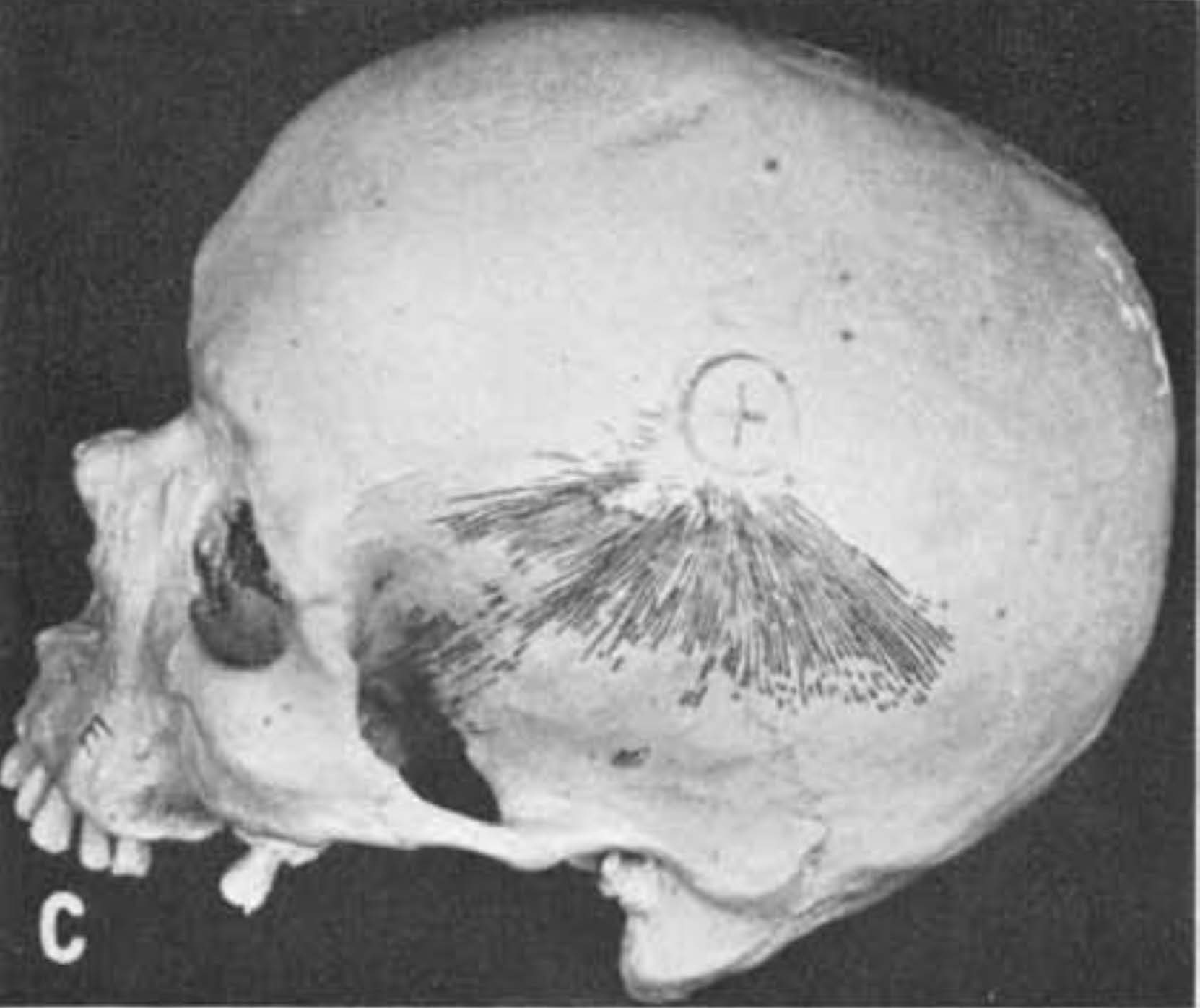 The Science of Skull Fracture